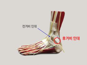 김영욱 교수, '만성발목불안정증 후거비인대에도 영향' 연구결과 발표
